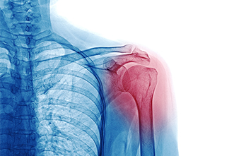 X ray of injured shoulder